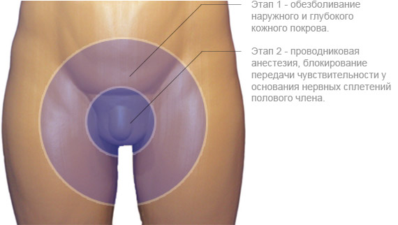 Эффективная и комфортная двухступенчатая анестезия.