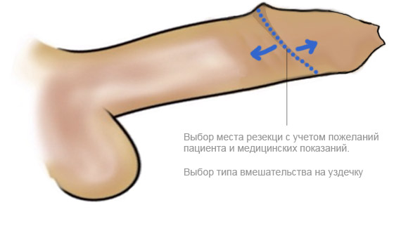 Делаем косметическую разметку учитывая индивидуальные особенности строения пениса.